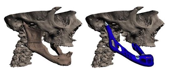 世界首例3D打印下颌移植手术细节公布